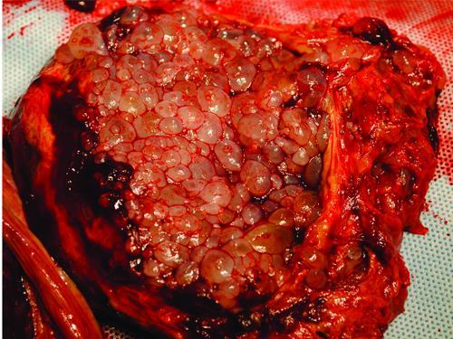 MOLA HYDATIDOSA Parciális mola Komplett mola Kariotípus hcg 69,XXY (XXX, XYY) 46,XX (XY) Embryo/foetus van (abnormális) nincs Choriocarcinoma kockázata <0,5% 2-3%