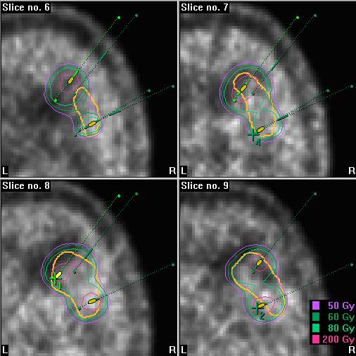 A sárga kontúr a jobb oldali insularis daganat (Astrocytoma WHO Grade II.) határát jelöli a besugárzás előtt készült CT felvételen. A 9.