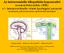 Az intracranialis idiopathiás koponyaűri nyomásfokozódás (IIH) +/- intracerebralis vénás keringési zavarok