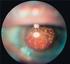 A retina szerkezet pathológiás változásainak vizsgálata optikai koherencia tomográfiás képek szegmentálásával