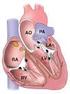 Idiopathiás fascicularis kamrai tachycardia ablatiója