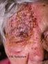 A rosacea patomechanizmusa. The pathomechanism of rosacea