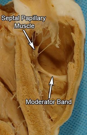 org/paper/morphology-of-moderator-bands- (septomarginal-in-gulyaeva-