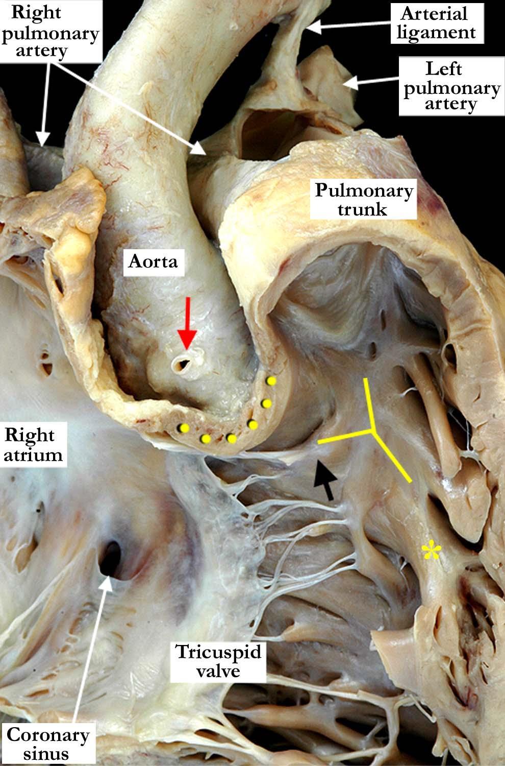 VENTRICULUS DEXTER CRISTA SUPRAVENTRICULARIS: cuspis septalis alatt