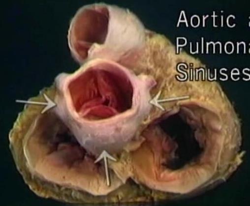 dextra L: Valvula semilunaris sinistra R: Valvula semilunaris dextra P: Valvula