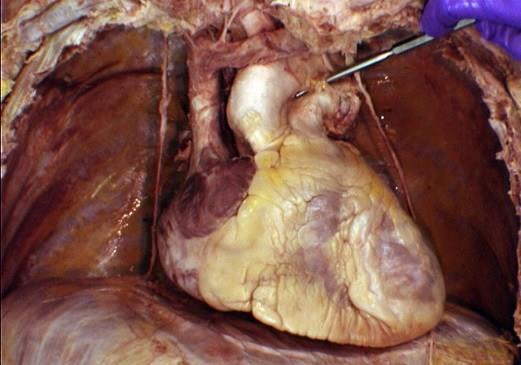 left subclavian artery 10.right auricle 11.left auricle 12.fat 13.