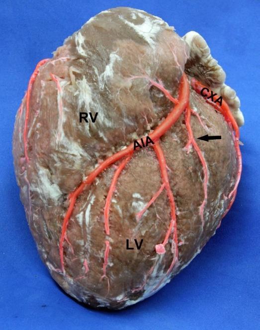 ARTERIA CORONARIA SINISTRA eredése: sinus aortae sinister ÁGAI: 1. RAMUS INTERVENTRICULARIS PARACONALIS 2. RAMUS CIRCUMFLEXUS SIN. A.