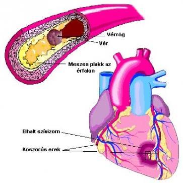 KORONÁRIÁK a koronáriák ágai funkcionális végartériák nincs köztük anasztomózis