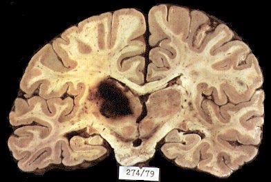 A thalamus