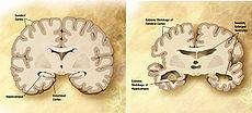 Általános jellemzők Az Alzheimer kór a szenilis demenciák leggyakrabban előforduló formája, melyet Alois Alzheimer 1906-ban írt le (Berchtold és Cotman, 1998).