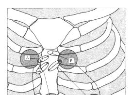 Sites for auscultation The loudness of heart sounds changes