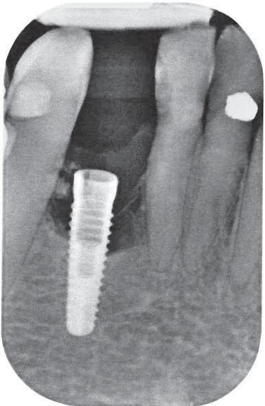 Implantaten.