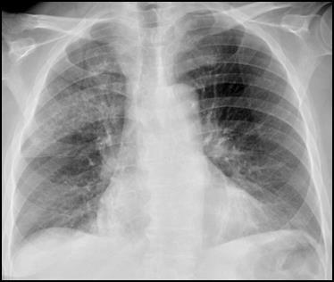 Pneumonia Dr.