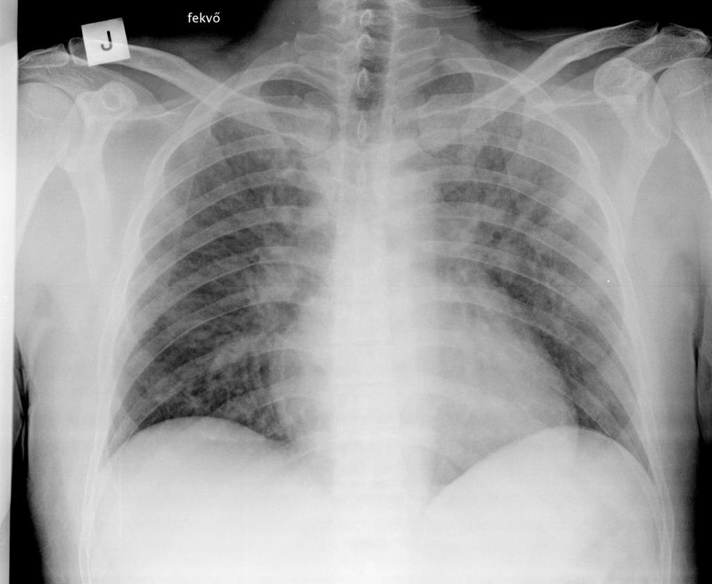 Pneumocystiis yiroveci pneumónia a valamennyi