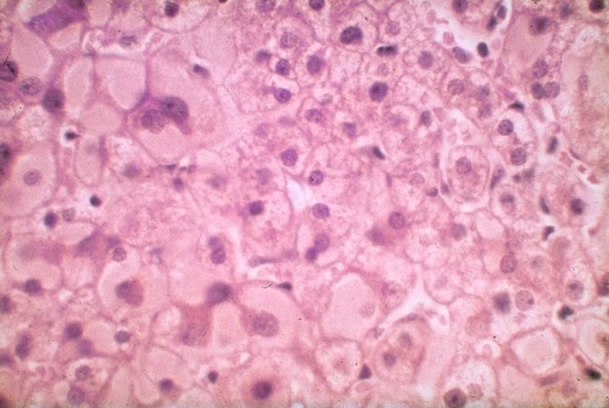 HBV hepatitis Immunválasz Teljes replikáció A 1. Fokozott 2. Fulmináns hepatitis HDV? 1. Acut hepatitis Teljes virus gén expreszszió A HB-sAg HBcAg/ HBeAg 2.