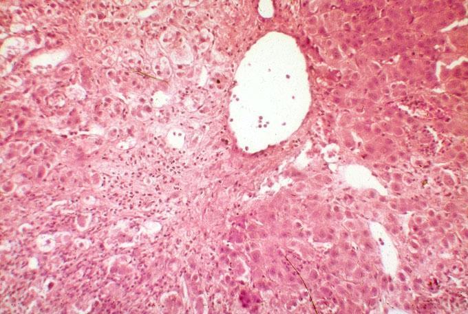 Cirrhosis hepatis-3 Alkoholos májbántalom 1.