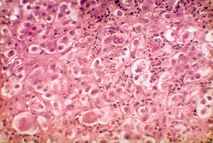 Alkoholos májbántalom 1. Steatosis hepatis reverzibilis 2.