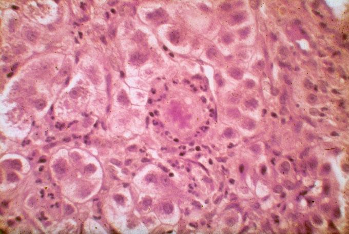 granulocytás lobulitis granulocyta koporsó, - Mallory-test ( CK+ eosinophil zárvány - pericentrális