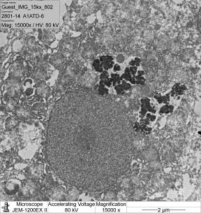 hepatitis talaján HBV+ CH HCV CH Autoimmun hepatitis