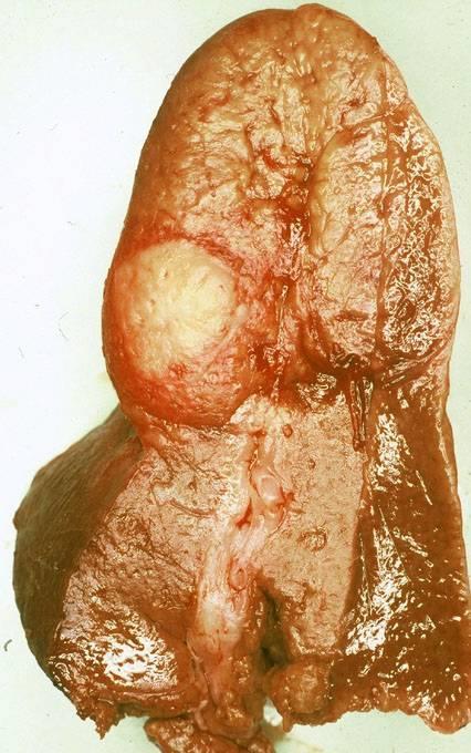 Focal liver