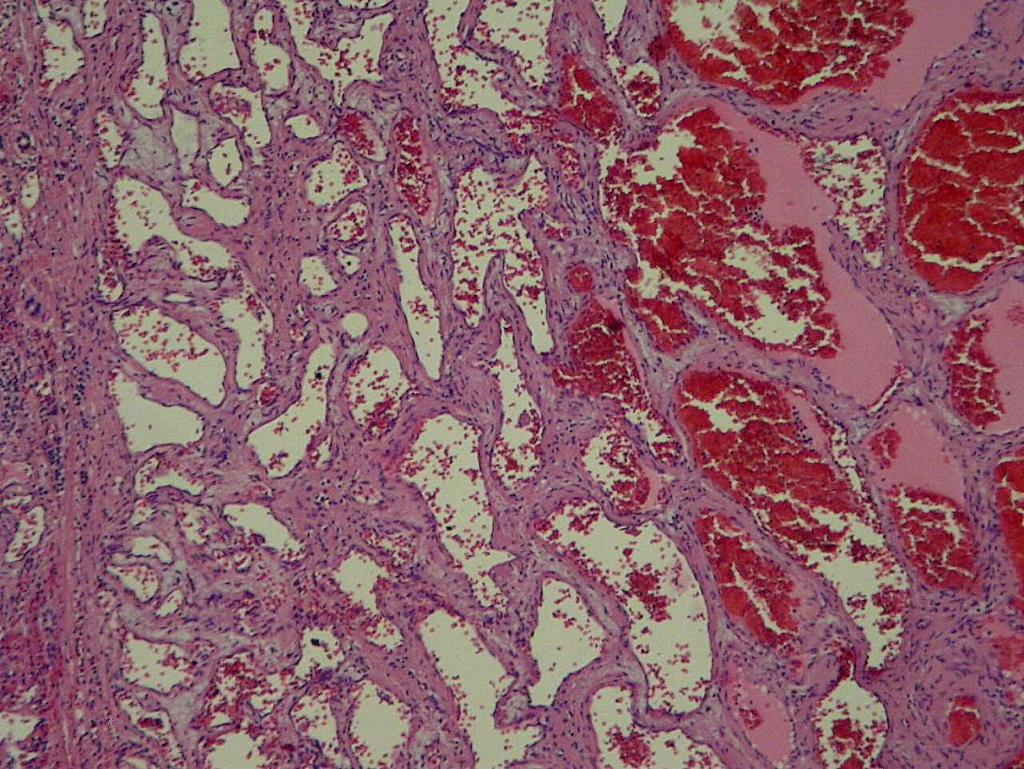 Haemangioma