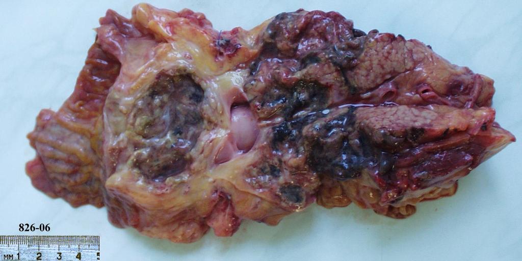 Pancreatitis acuta haemorrhagica et Pseudocysta capitis pancreatis (25%) PARS DESCENDENS DUODENI Marsupialia Marsupial Pancreatitis chronica