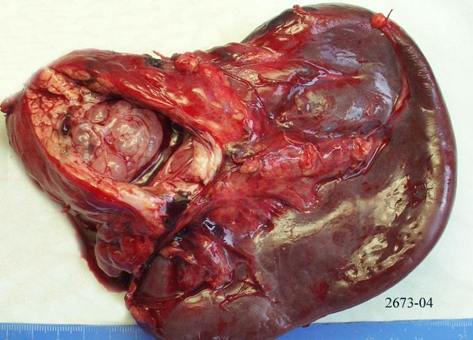 Pancreas tumorok 1. Endocrin rész - Neuroendocrin tumorok, gastrin-/insulinoma, stb - Nesidioblastosis 2.