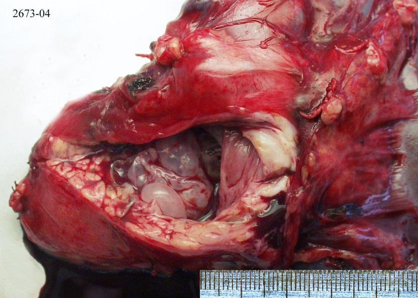 Cystadenoma serosum 2. Cystadenoma mucinosum (MCN) - denz stroma, kisebb ductusokból > 95% nő, 1/3-a invasiv 3.