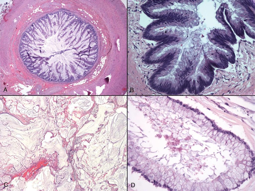 Mucokele processus vermiformis