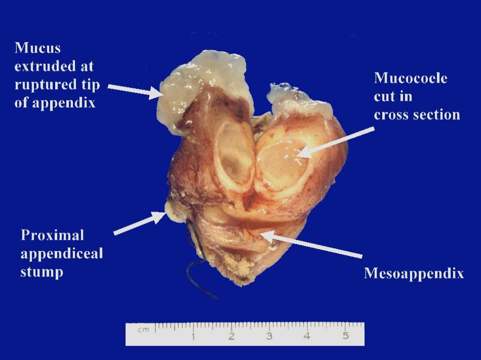 Mucokele processus