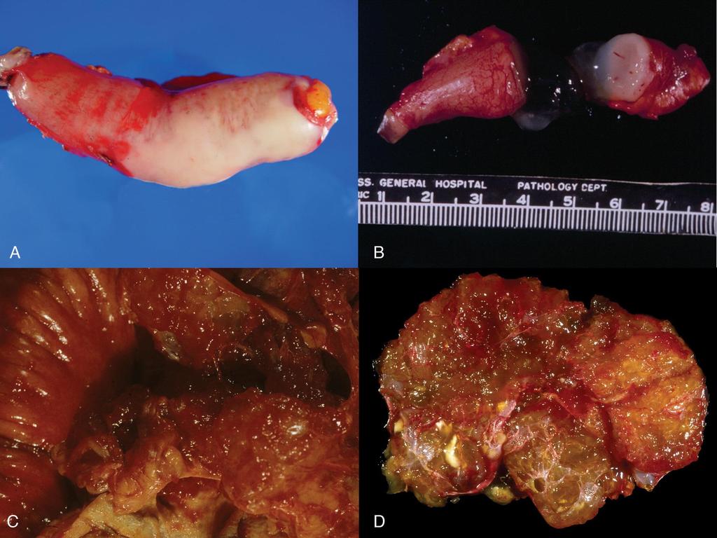 Mucokele processus vermiformis www.