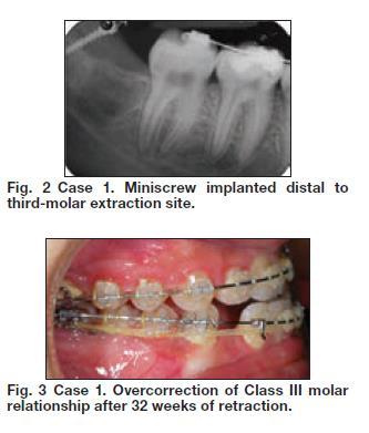 Retromolar miniscrew