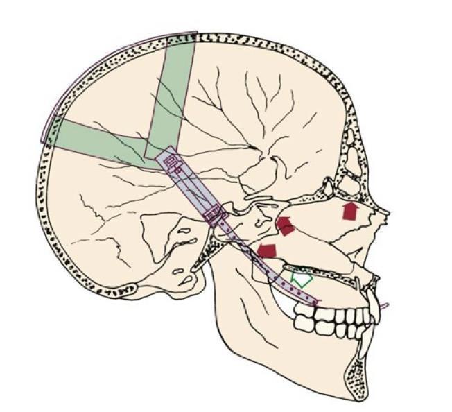 Treatment of Malocclusion of the