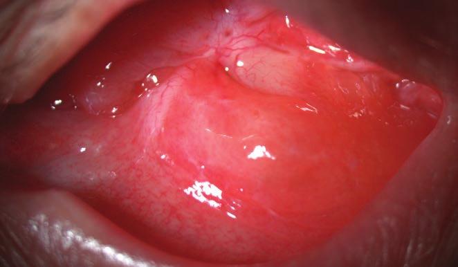 Három esetben kellett implantációs ciszta miatt műtétet végezni két esetben szekunder implantáció egy esetben primer beültetés után alakult ki a subconjunctivalis ciszta.