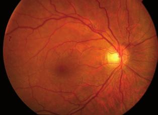 Esophoria, aquired hyperopia with choroidal folds BEVEZETÉS Az opticus hüvely meningocele (ONSM) egy ismeretlen etiológiájú rendkívül ritka kórkép, amelyre jellemző a periopticus subarachnoide - ális
