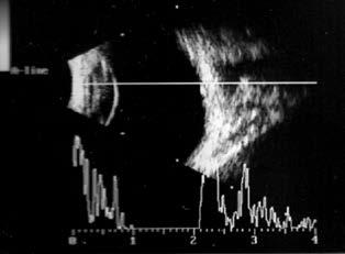 Esophoria, hypermetropia és chorioidea 3. ábra: Ultrahang B-scan jobb és bal szemről. A bulbusok mögött (od. 6,3 7,0 mm, o.sin.