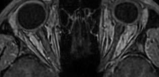 Coro - nális metszeten látható mindkét oldalon a nervus opticust körülvevő dilatált, hiper denz opti cushüvely, mely ökörszemhez (bull s eye) hasonlatos B tubularis-cisztikus kiszélesedése volt