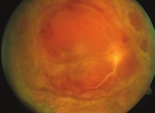 Acute retinal necrosis Case report and literature review 1. ábra: 1. Beteg: Va - ric ella zoster vírus (VZV) eredetű ARN szemfenéki képei. A: Retina nekrózis vérzésekkel, akut szakaszban.
