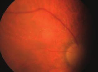 Vizsgálata során 0,8/1,0 látóélesség, normális szemnyomás mellett jobb oldalon enyhe elülső uveitist, vitritist és a retina perifériáján fehér foltos területeket észleltünk.