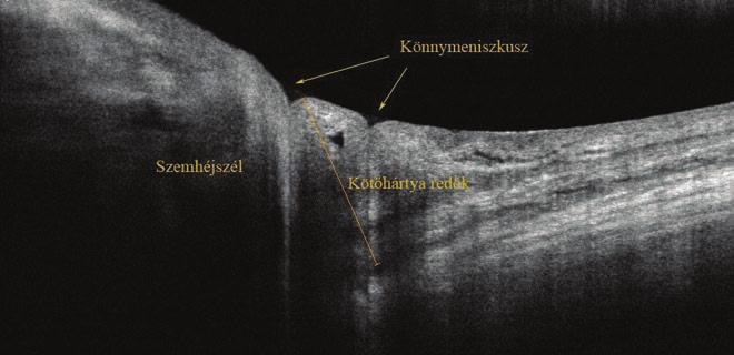 New diagnostical procedures of the ocular surface böző betegcsoportokon. Jelen öszszefoglaló közlemény célja a tapasztalataink rövid ismertetése.