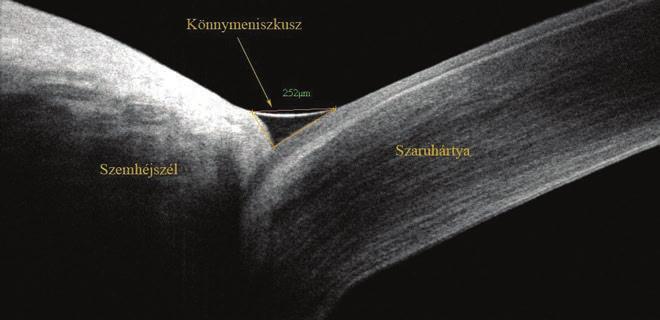 Újabb diagnosztikai módszerek a szemfelszín megbetegedéseiben 3.