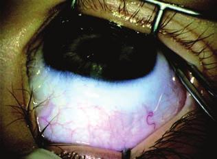 A normális újszülöttkori cor nea-átmérő 9,5-10,5 mm, amely egyéves életkorra 10,0-11,5 mm-re növekszik. Minden 12-12,5 mm fölötti cornea-átmérő abnormálisnak tekintendő.