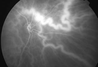 A maculát optikai koherencia tomográffal képeztük le (Stratus OCT: 4.1 verzió, 2012-től: RTVue 100 OCT). A műszerekbe épített szoftver segítségével meghatároztuk a retina vastagságát.