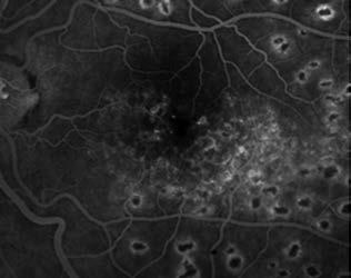 A hematológiai vizs gálat familiáris trombo filiát, antifoszfolipid-szindrómát nem iga zolt (INR, aktivált parciális tromboplasztin-idő, trombin-idő, fibrinogén, D-dimer, anti trom bin III, protein