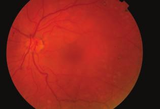Retinal vein occlusion and intracerebral aneurysm in a young adult 4. ábra: A maculaödéma változása a 2. intravitre - alis dexamethason implantáció után Fundusfotó és OCT-leképezések.
