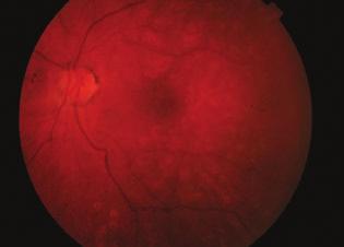 Bár az anamnézisben trauma nem szerepelt, az orbita ultrahangvizsgálata során carotideo-cavernosus fisztulára utaló jeleket kerestünk. Az a.