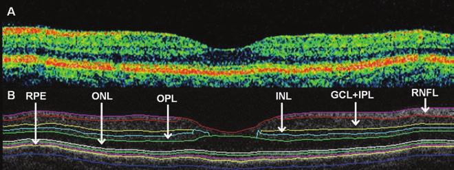 The in vivo assessment of retinal structure 1. ábra: A macula OCT-képének szegmentációja az OCTRIMA-szoftver segítségével. A: Egy egészséges macula képe a Stratus OCT lassú programjával leképezve.