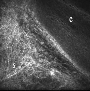 In vivo confocal corneal microscopy of the conjunctiva amellyel a bazálmembránban immunglobulin-a vagy -G, vagy a 3-as komplementfaktor lerakódását bizonyítjuk.
