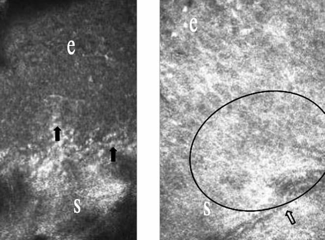 A kötőhártya in vivo konfokális cornea-mikroszkópiája 4. ábra: Kötőhártya konfokális cornea-mikroszkópiás képe. A: Kontrollszemeken az epithelium élesen elkülönül a stromától (fekete nyilak).