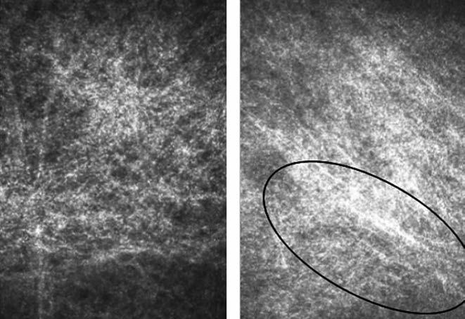 ábra: Kötőhártya konfokális cornea-mikroszkópiás képe. A: Kontrollszemeken a stroma szerkezete egyenletes, a rostok finoman hullámos vonalúak.